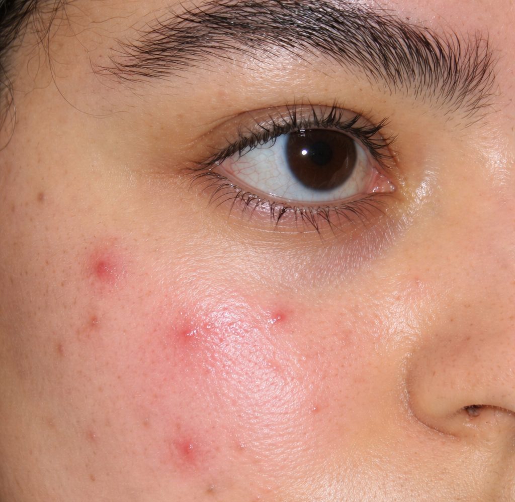 Targets visible redness